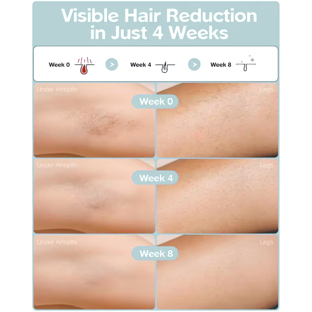 SPABLUE laser hair removal device