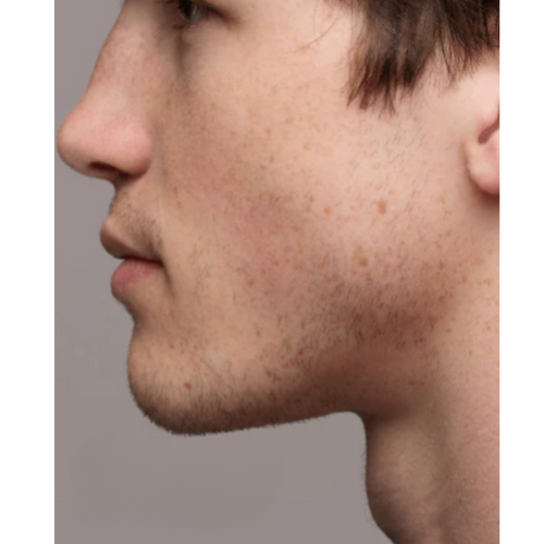 Before image for Noah M.